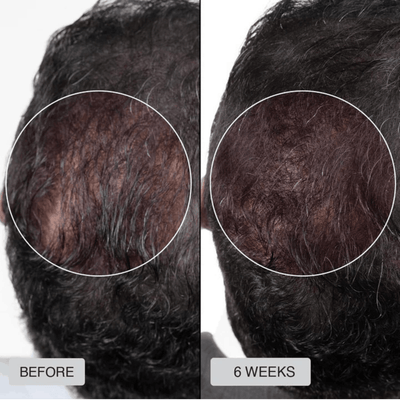 Red Light Therapy Cap for Hair Regrowth Treatments
