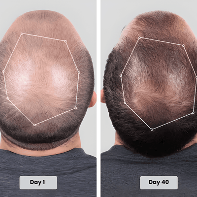 Red Light Therapy Cap for Hair Regrowth Treatments